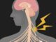 Ilustración del nervio vago desde el cerebro hasta el cuerpo, con un estimulador implantado que emite una descarga