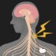 Ilustración del nervio vago desde el cerebro hasta el cuerpo, con un estimulador implantado que emite una descarga